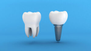 What Food to Avoid After You Get Dental Implants?