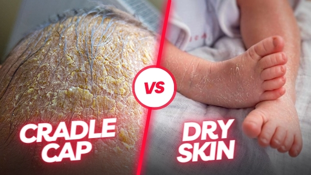 cradle cap vs dry skin
